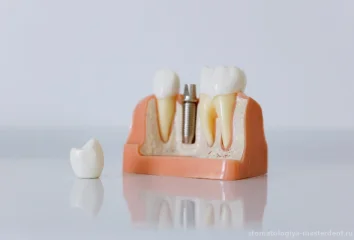 Имплантация зубов по самым доступным ценам